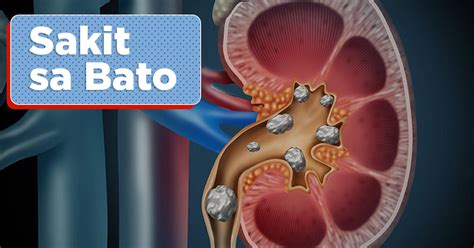 iba't ibang uri ng bato|Mga Bato sa Kidney .